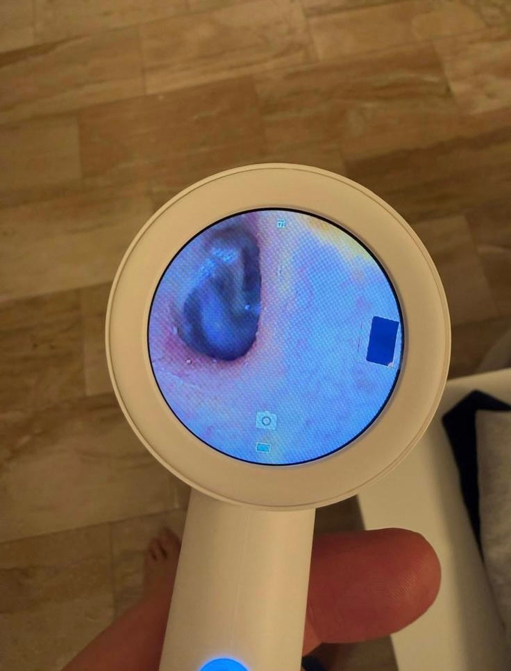 Otoscopie